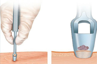 Captura Híbrida para HPV