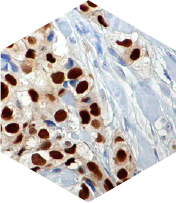 Painel Imunohistoquímico para o Câncer de Mama (RE,RP,Ki67,HER-2)